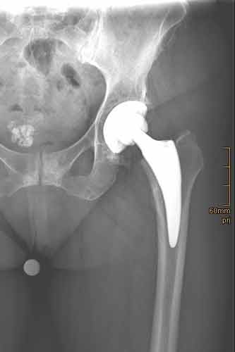 Coxarthrose links