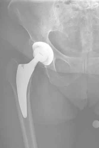 Coxarthrose rechts