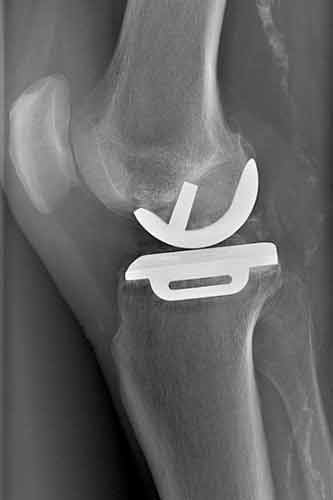 Varusgonarthrose