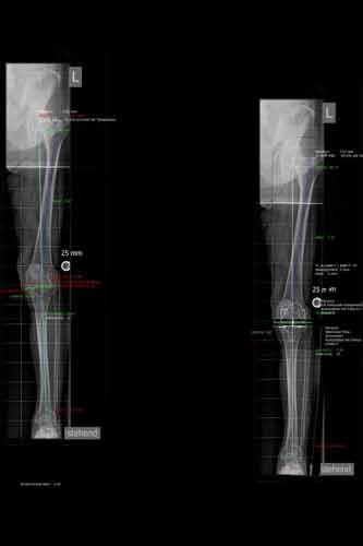 Gonarthrose links