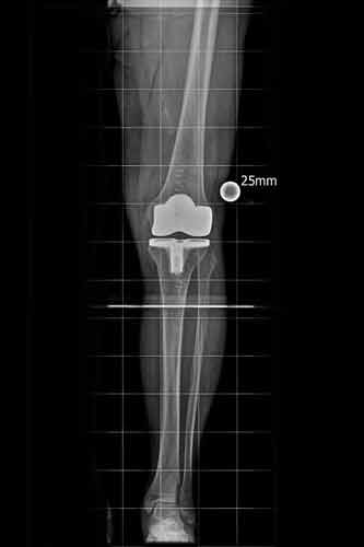 Gonarthrose links