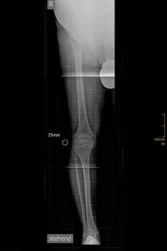 Gonarthrose rechts