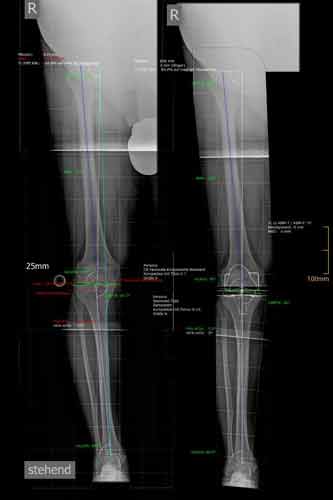 Gonarthrose rechts