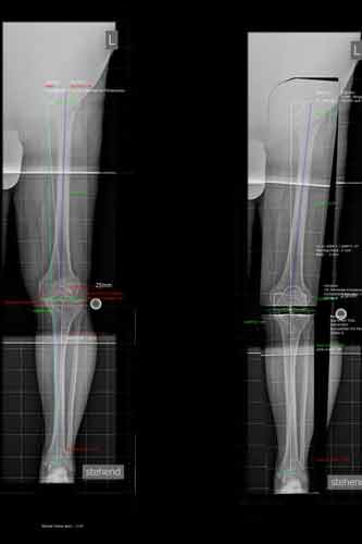 Gonarthrose links