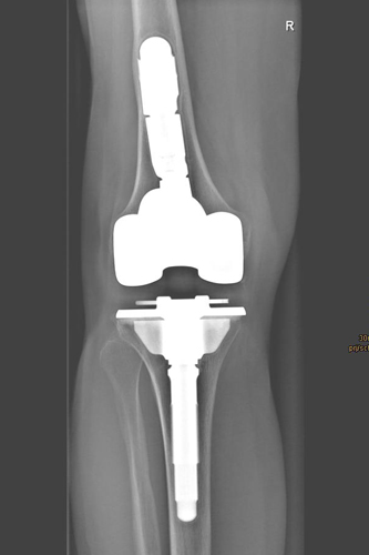 Revisionsoperation mit Vanguard 360 Spezialprothese