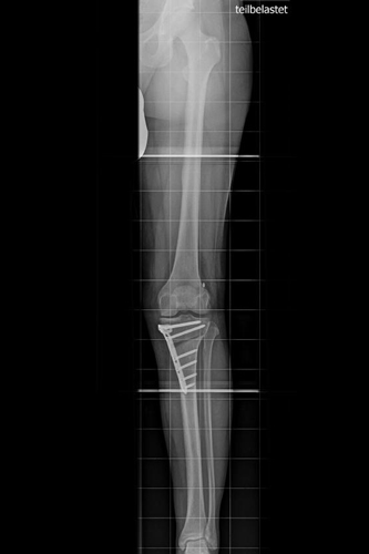 O - Bein nach Umstellungsoperation