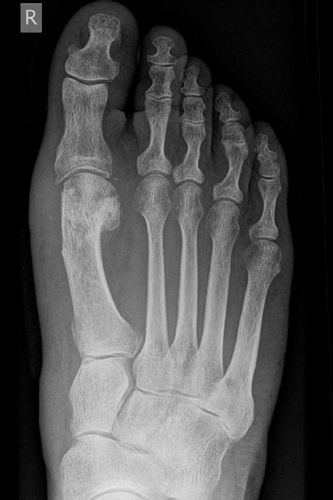 Hallux valgus nach Korrektur