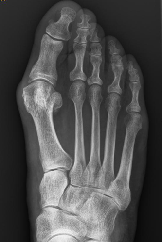 Hallux valgus