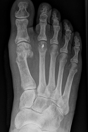 Hallux valgus nach Korrektur