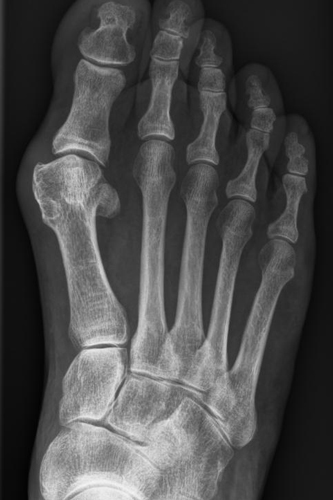 Hallux valgus