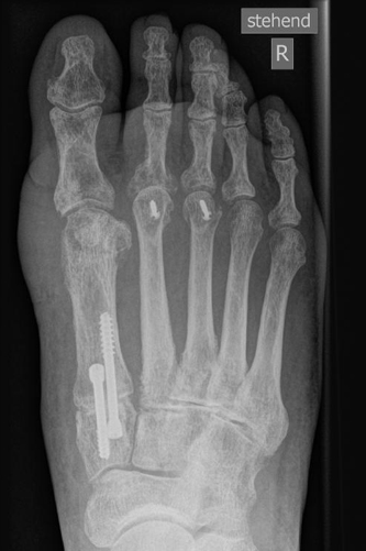 Hallux valgus nach Lapidus Arthrodese