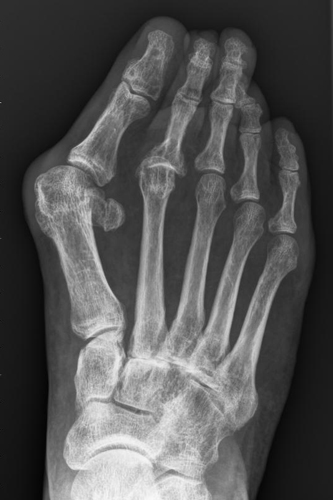 Hallux valgus